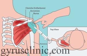 Steroid injections shoulder tendonitis