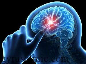 پیشگیری از سکته مغزی
